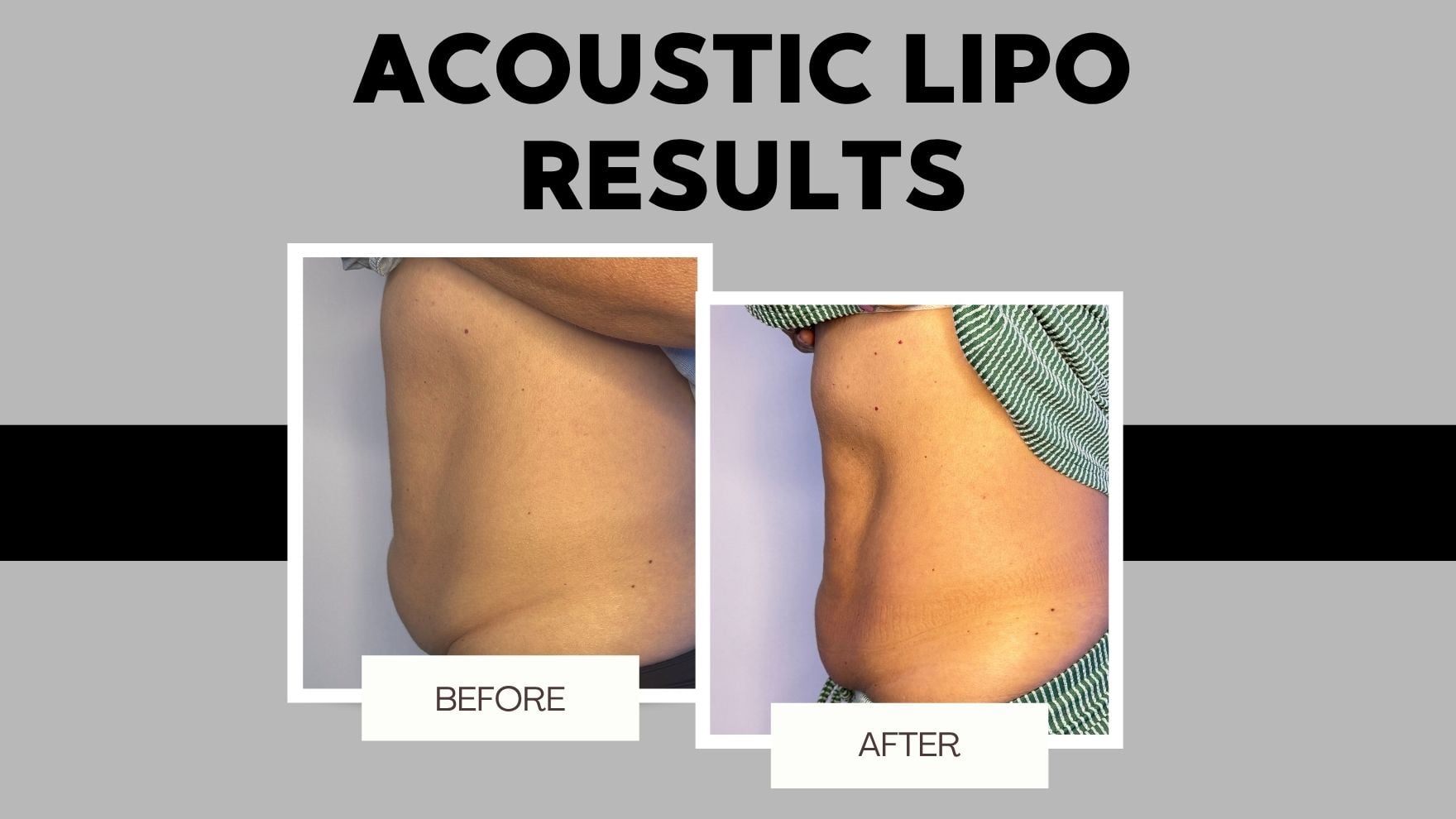 Before and after body sculpting in Muscle Shoals