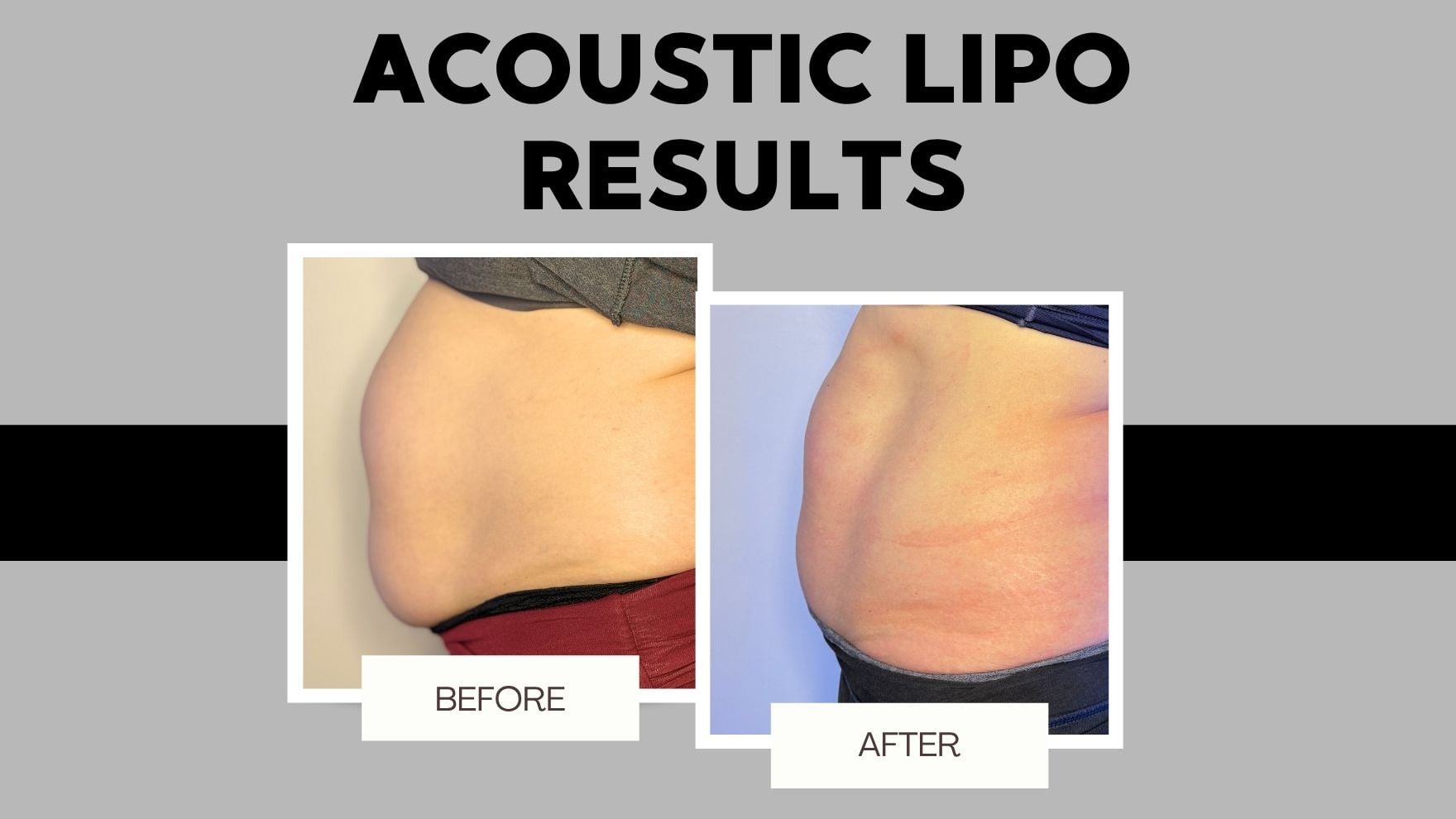 Before and after body sculpting in Muscle Shoals